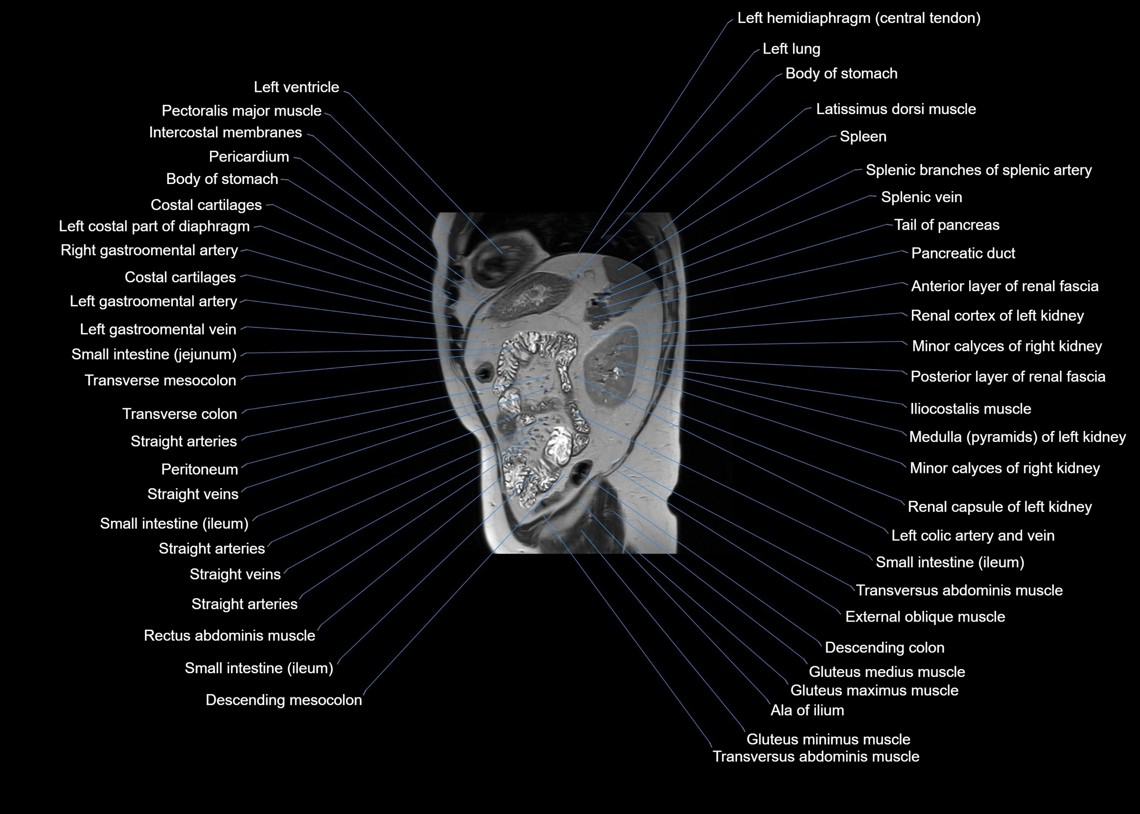 MRI abdomen sagittal cross sectional anatomy  radiology  image-img-00001-00053.webp